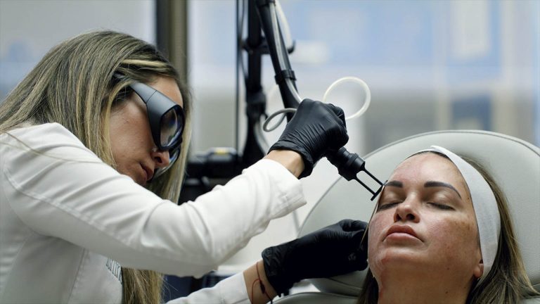 Dra. Beatriz Lam 03 – Láser CO2