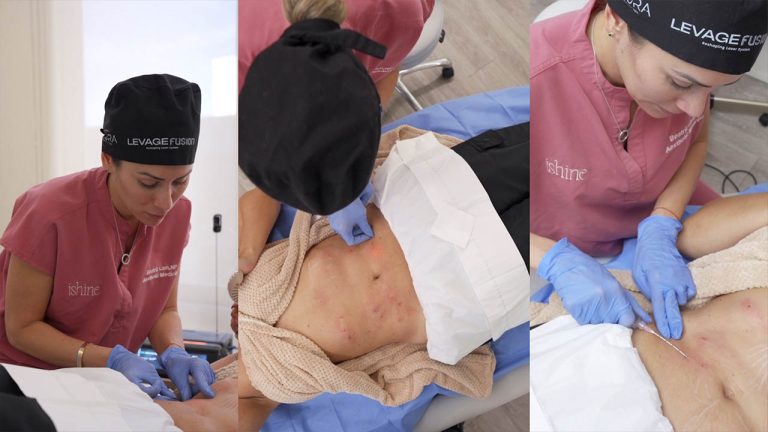 Dra. Beatriz Lam 04 – Endolaser